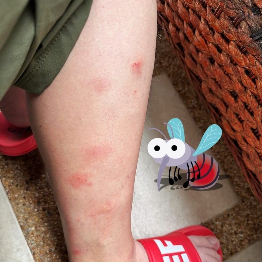 Mückenstiche in Thailand – Beurer BR 10 zeigt sofort Wirkung Mehrere frische Mückenstiche am Bein in Thailand, direkt behandelt mit dem Beurer BR 10 Insektenstichheiler, nur leichte Rötung sichtbar.